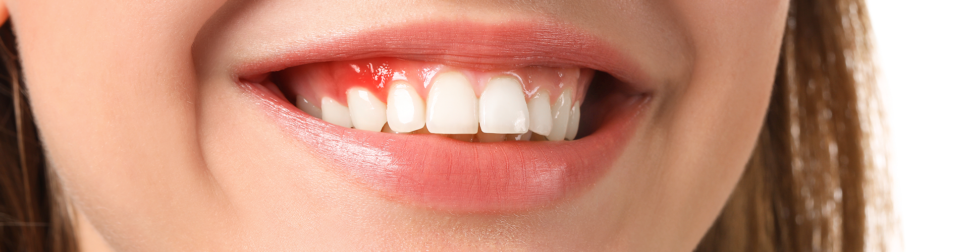 Closeup photo of woman's smile with red gums.